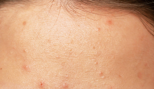Is Your Skin Purging or Breaking Out?